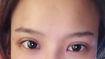 長春麥西美嘉整形醫(yī)生王圣博做雙眼皮手術效果怎么樣？附雙眼皮案例