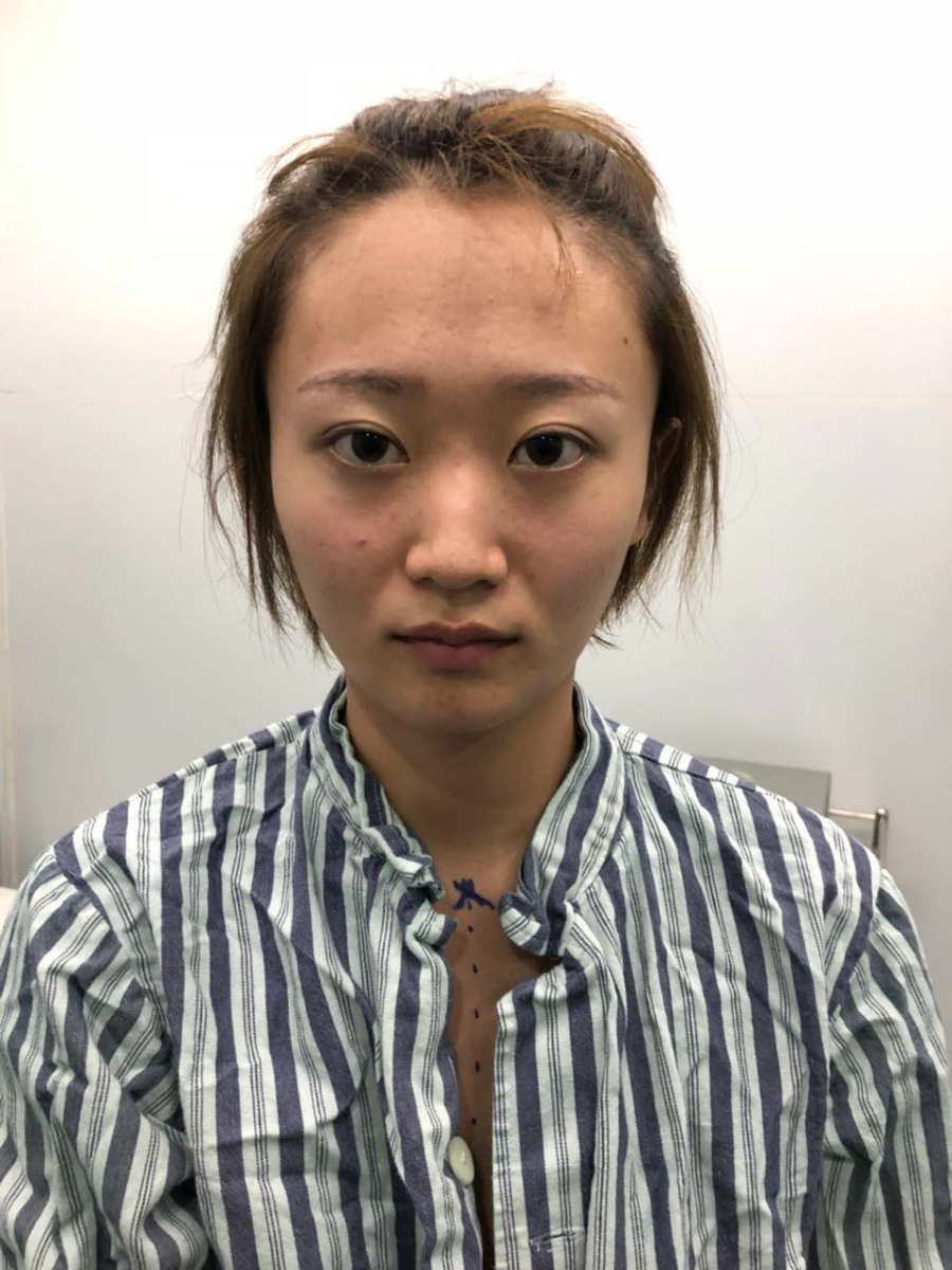 杭州迪美整形常德成醫(yī)生做鼻綜合整形技術(shù)怎么樣？附鼻綜合整形案例