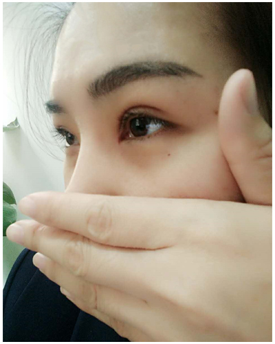 營(yíng)口臻美醫(yī)療整形醫(yī)生閆迎軍做雙眼皮效果怎么樣？附雙眼皮案例對(duì)比圖