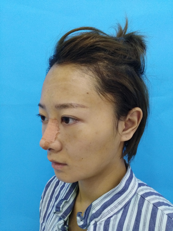杭州迪美整形常德成醫(yī)生做鼻綜合整形技術(shù)怎么樣？附鼻綜合整形案例