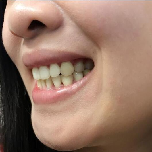 重慶嘉悅口腔醫(yī)院周繼祥醫(yī)生做金屬托槽矯正效果怎么樣？附案例效果對(duì)比圖