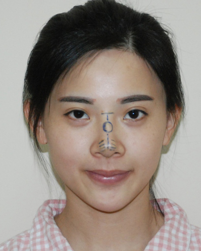 襄陽維多利亞整形醫(yī)院安邰晥醫(yī)生做鼻綜合整形怎么樣？附鼻綜合整形案例