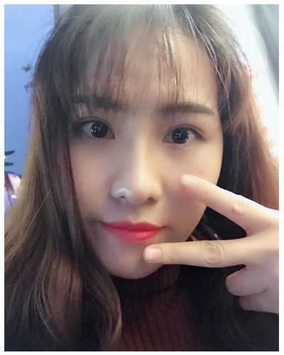營(yíng)口臻美醫(yī)療整形醫(yī)生閆迎軍做雙眼皮效果怎么樣？附雙眼皮案例對(duì)比圖