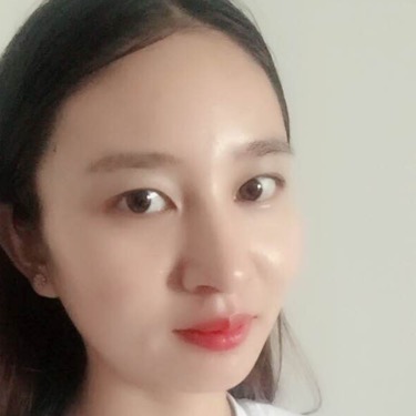 武漢維納斯整形醫(yī)院趙瑾醫(yī)生做玻尿酸墊下巴怎么樣？附玻尿酸墊下巴案例