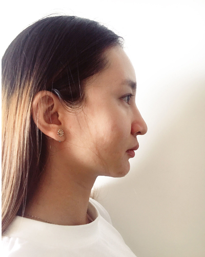 武漢維納斯整形醫(yī)院趙瑾醫(yī)生做玻尿酸墊下巴怎么樣？附玻尿酸墊下巴案例