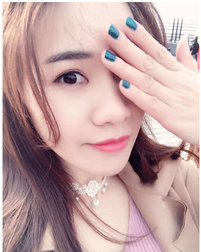 營(yíng)口臻美醫(yī)療整形醫(yī)生閆迎軍做雙眼皮效果怎么樣？附雙眼皮案例對(duì)比圖