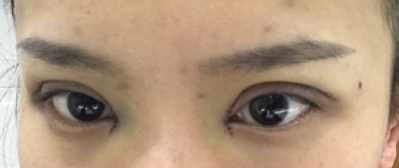 長春麥西美嘉整形醫(yī)生王圣博做雙眼皮手術效果怎么樣？附雙眼皮案例
