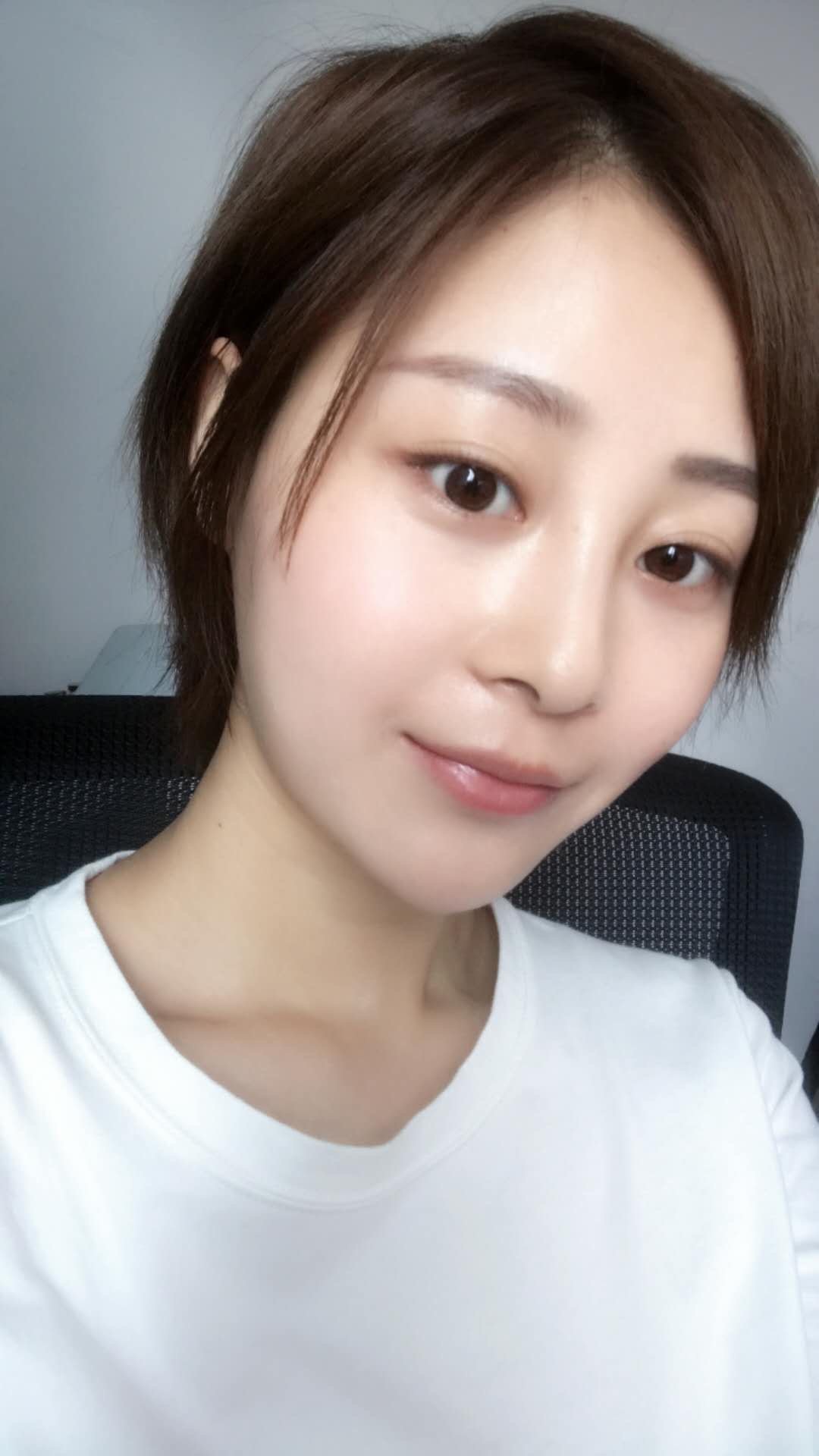 天津歐華威莎整形醫(yī)生姚玲做面部埋線提升效果怎么樣？附埋線提升案例