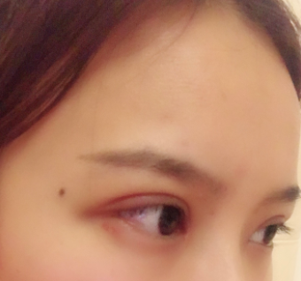 長春麥西美嘉整形醫(yī)生王圣博做雙眼皮手術效果怎么樣？附雙眼皮案例