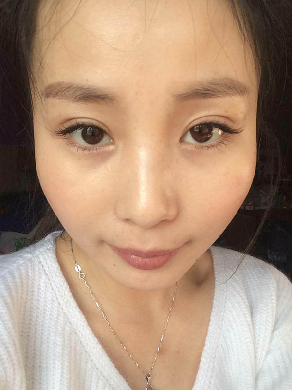 桂林新華醫(yī)療美容醫(yī)生李新華做雙眼皮手術(shù)怎么樣？李新華雙眼皮手術(shù)案例