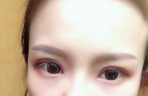 長春麥西美嘉整形醫(yī)生王圣博做雙眼皮手術(shù)效果怎么樣？附雙眼皮案例