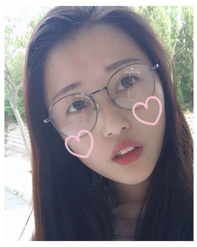 義烏傅氏口腔醫(yī)生朱雨晴做牙齒隱形矯正效果怎么樣？附牙齒隱形矯正案例