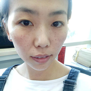 珠海蒂伊醫(yī)療整形醫(yī)生廖俊凱做激光祛斑效果怎么樣？附激光祛斑案例效果圖
