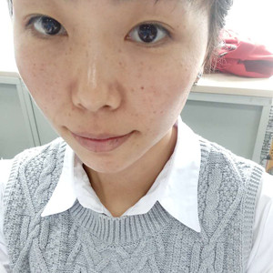 珠海蒂伊醫(yī)療整形醫(yī)生廖俊凱做激光祛斑效果怎么樣？附激光祛斑案例效果圖