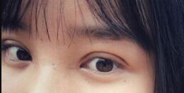 長沙微笑醫(yī)療整形醫(yī)生段雙軍做切開雙眼皮+開內(nèi)眼角效果怎么樣？附案例