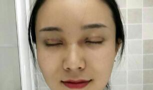 長沙微笑醫(yī)療整形醫(yī)生段雙軍做切開雙眼皮+開內(nèi)眼角效果怎么樣？附案例