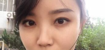 長沙微笑醫(yī)療整形醫(yī)生段雙軍做切開雙眼皮+開內(nèi)眼角效果怎么樣？附案例