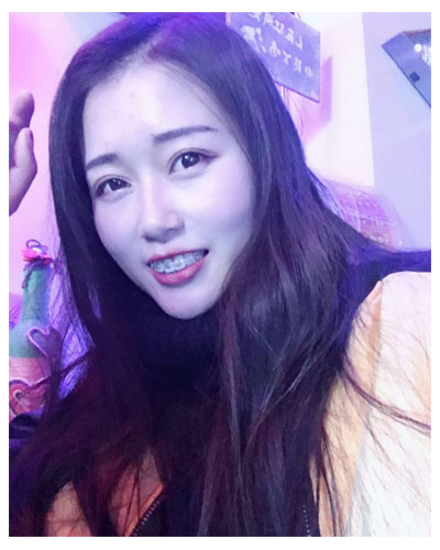 義烏傅氏口腔醫(yī)生朱雨晴做牙齒隱形矯正效果怎么樣？附牙齒隱形矯正案例