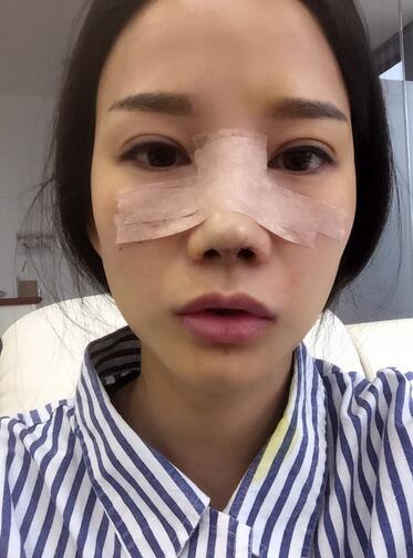 西安陽光整形醫(yī)院邵萍醫(yī)生做鼻綜合整形怎么樣？附鼻綜合整形案例