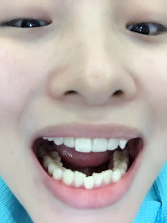 重慶齊美口腔周映丞醫(yī)生做牙齒隱形矯正怎么樣？附牙齒隱形矯正案例