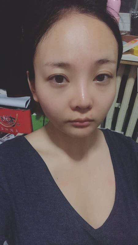 北京可思美醫(yī)療整形醫(yī)生蘇靜做臉部自體脂肪填充效果怎么樣？