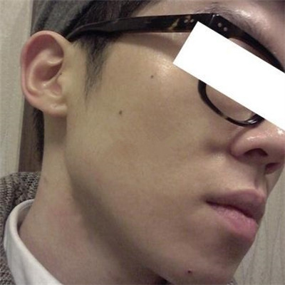 浙江綠城醫(yī)院整形美容中心丁路醫(yī)生做激光祛痘效果怎么樣，附案例對比圖