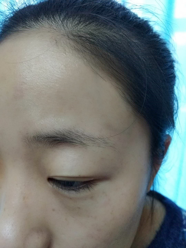 長(zhǎng)沙愛(ài)思特醫(yī)療美容醫(yī)院做半永久紋眉怎么樣？附彭子娟醫(yī)生案例效果圖