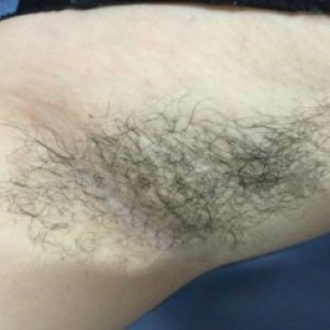廈門張銘整醫(yī)療整形醫(yī)生張小玲做激光脫腋毛怎么樣？附激光脫腋毛效果對(duì)比圖