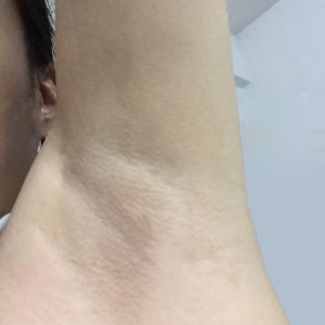 廈門張銘整醫(yī)療整形醫(yī)生張小玲做激光脫腋毛怎么樣？附激光脫腋毛效果對(duì)比圖