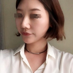太原麗都整形醫(yī)院劉晉艷醫(yī)生做光纖溶脂瘦臉怎么樣？附案例效果對(duì)比圖
