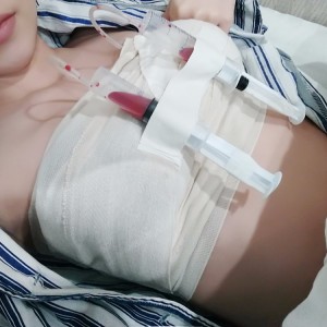廣州廣大整形美容醫(yī)院醫(yī)生查旭山做假體隆胸怎么樣？附案例