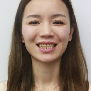 安慶渡江口腔醫(yī)院張良斌醫(yī)生牙齒貼面怎么樣？附牙齒貼面效果圖