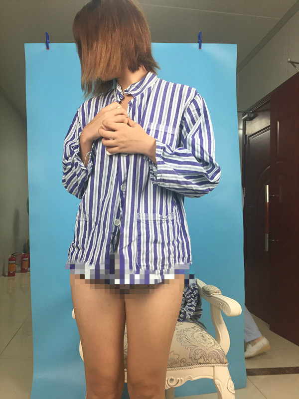 北京蒂凡妮整形靳玉彪醫(yī)生做大腿吸脂怎么樣？附大腿吸脂案例效果對比圖