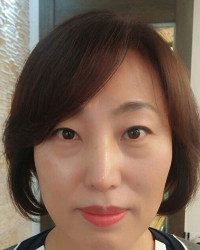 北京四季美學炫美整形醫(yī)生高玲做埋線祛眼袋怎么樣？附案例效果對比圖