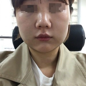 太原麗都整形醫(yī)院劉晉艷醫(yī)生做光纖溶脂瘦臉怎么樣？附案例效果對(duì)比圖