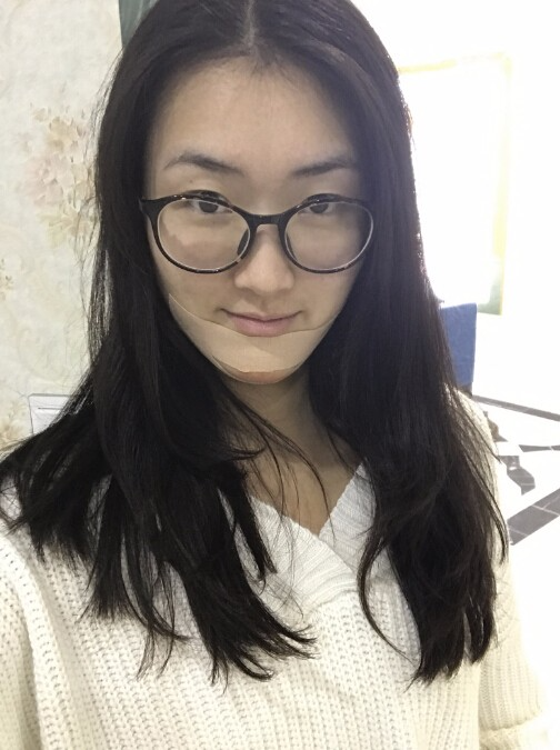 武漢中翰整形外科醫(yī)院做硅膠墊下巴怎么樣？附朱紅霞醫(yī)生案例效果對比圖