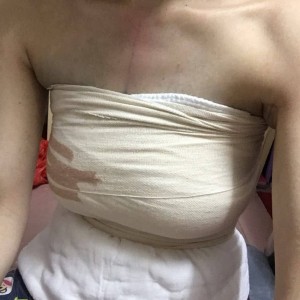 佛山東方女子醫(yī)院整形美容中心姜政輝做自體脂肪隆胸案例效果對(duì)比圖