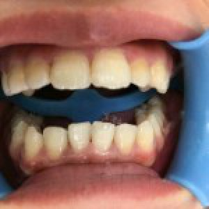 洛陽友好口腔醫(yī)院醫(yī)生楊愛芳做牙齒冷光美白怎么樣？附案例效果圖