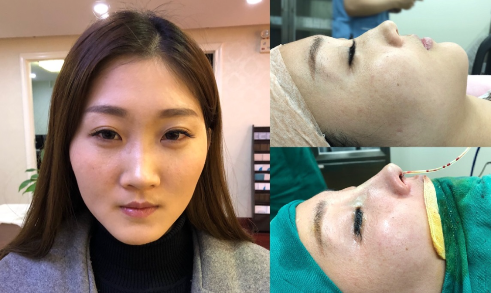 上海首爾麗格醫(yī)療美容醫(yī)院醫(yī)生樸晟秀做膨體隆鼻怎么樣？附案例效果圖