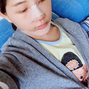 北京京民醫(yī)院整形外科醫(yī)生李鴻儒做硅膠隆鼻怎么樣？附案例效果圖