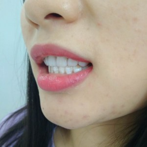 洛陽友好口腔醫(yī)院醫(yī)生李新然做牙貼面怎么樣？附案例效果圖