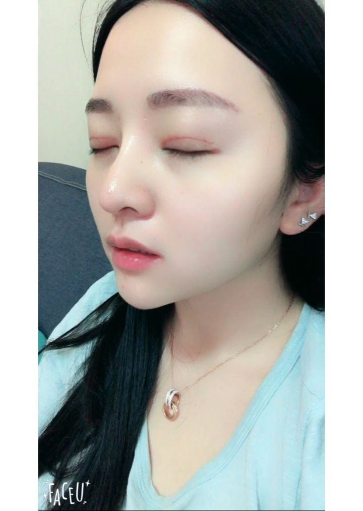 北京京韓整形醫(yī)生王義山做埋線雙眼皮怎么樣？附案例效果對比圖