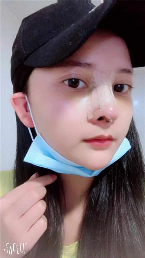 鄭州華領(lǐng)醫(yī)療美容醫(yī)院醫(yī)生張永濤做硅膠假體隆鼻怎么樣？附案例效果對比圖