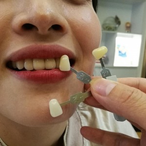 上海科瓦口腔醫(yī)院醫(yī)生鄧建儒做牙齒冷光美白怎么樣？附案例效果對比圖