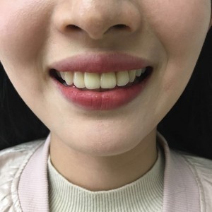 上?？仆呖谇会t(yī)院醫(yī)生鄧建儒做牙齒冷光美白怎么樣？附案例效果對比圖