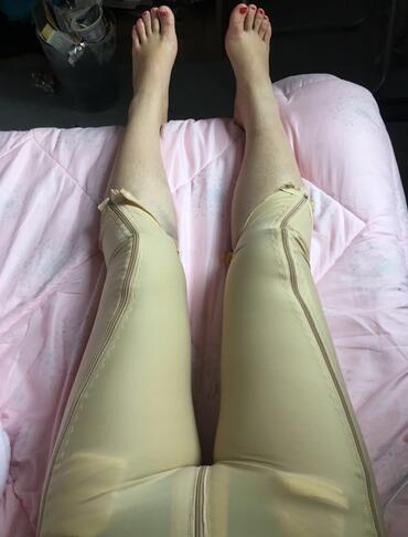 上海保加醫(yī)療美容門診部做大腿吸脂怎么樣？附楊勇醫(yī)生案例效果對(duì)比圖