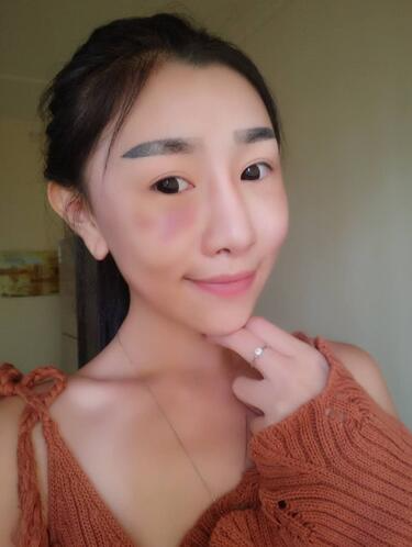 貴陽(yáng)泰康樂(lè)醫(yī)院整形美容科醫(yī)生陳璐做自體脂肪全臉填充效果怎么樣？