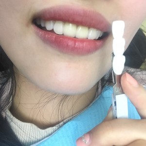 上?？仆呖谇会t(yī)院醫(yī)生鄧建儒做牙齒冷光美白怎么樣？附案例效果對比圖