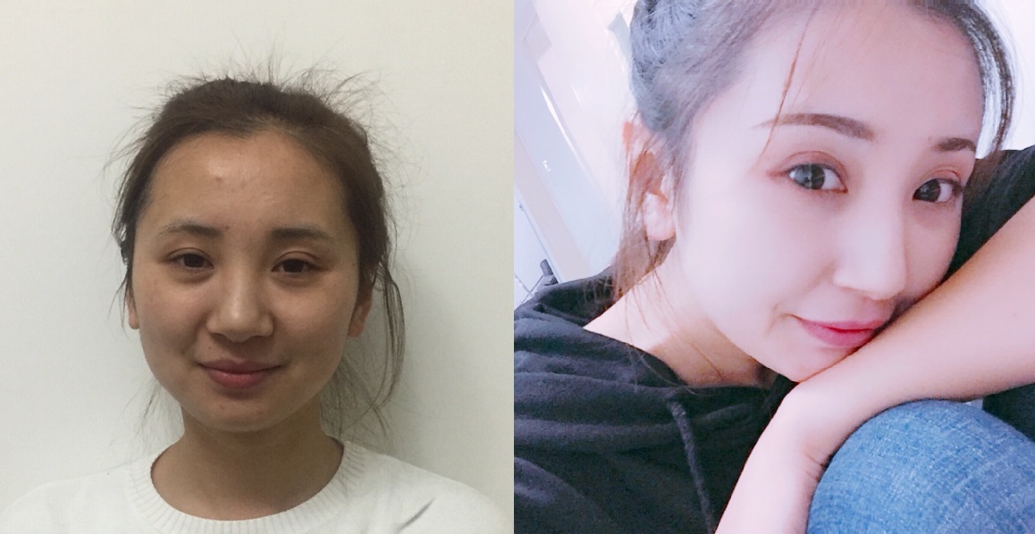 貴陽藝齡醫(yī)療美容門診部醫(yī)生李章做隆鼻手術(shù)怎么樣？附案例效果對(duì)比圖