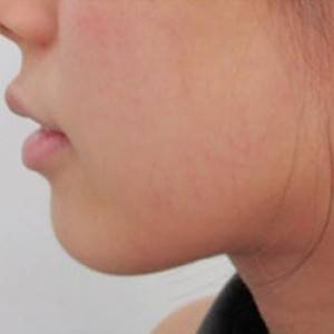 蚌埠韓美美萊整形醫(yī)院醫(yī)生張濤做玻尿酸墊下巴怎么樣？來看案例效果圖